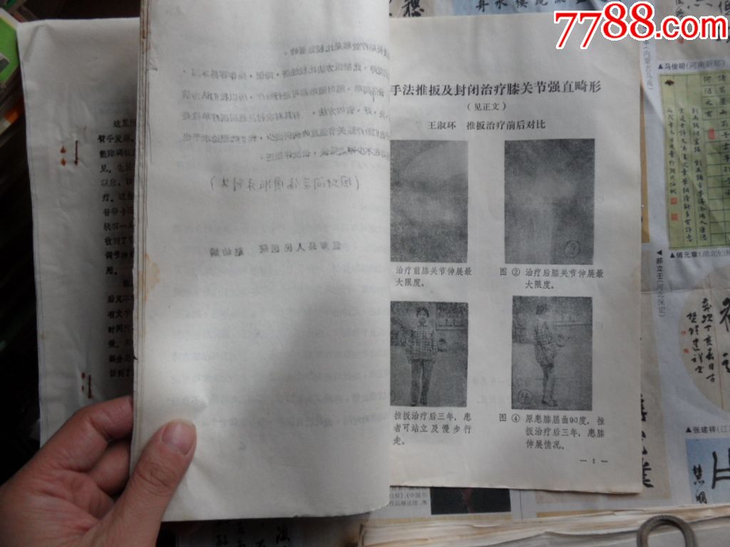用手法推板及封闭治疗膝关节强直畸形-医书\/药